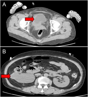 3D laparoscopic treatment of bladder cancer with pelvic multi-organ invasion: a case report and literature review